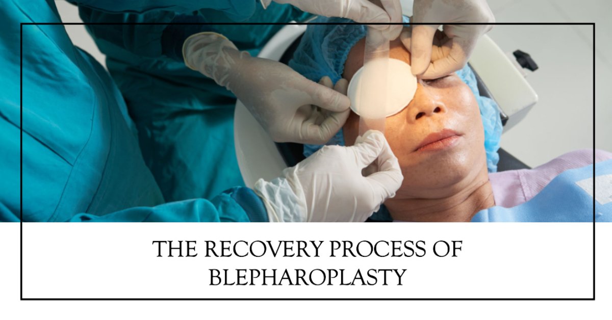 The Recovery Process of Blepharoplasty: What to Expect After Your Procedure? at Visage by Dr Priti, Chennai