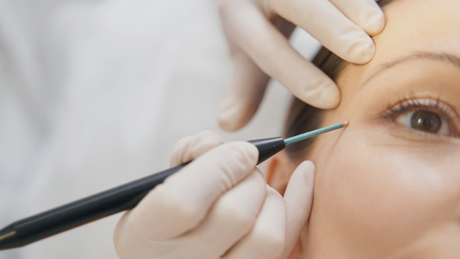 The Recovery Process of Blepharoplasty: What to Expect After Your Procedure? at Visage by Dr Priti, Chennai