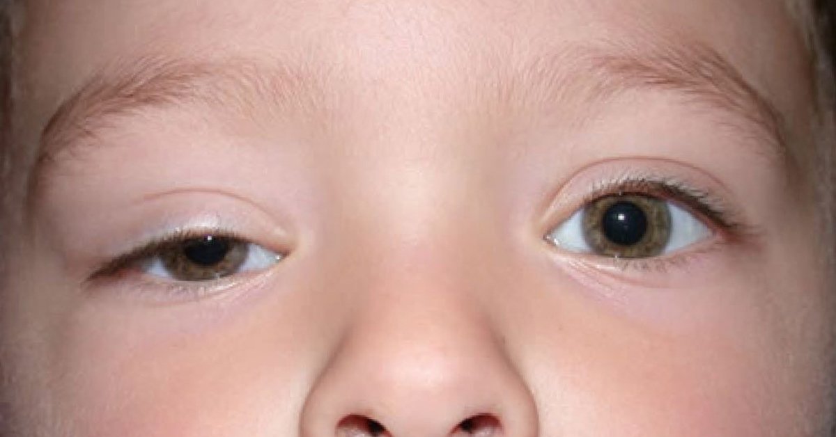 What is Eyelid Ptosis, What Causes It, and What are the Treatment Options? at Visage by Dr Priti, Chennai