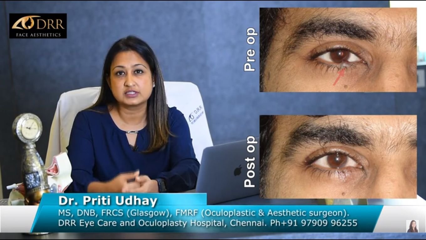 Eyelid Tumour Removal and Reconstruction, Surgery & Procedure at Visage by Dr Priti, Chennai