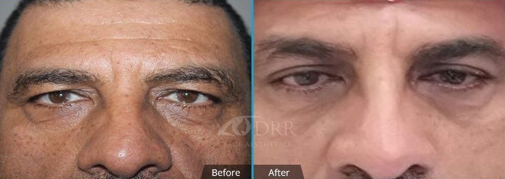 Blepharoplasty, before and after