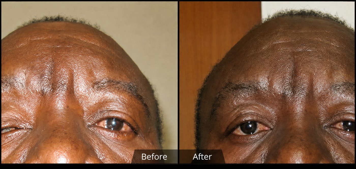 Artificial eye, before and after