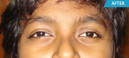 artificial eyes after treatment