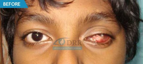 artificial eyes before treatment
