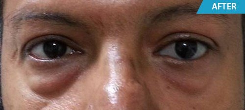 artificial eyes after treatment