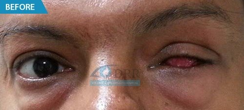 artificial eyes before treatment