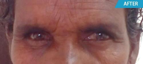 artificial eyes after treatment