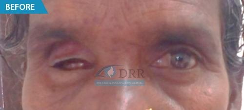 artificial eyes before treatment