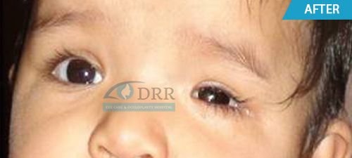 artificial eyes after treatment
