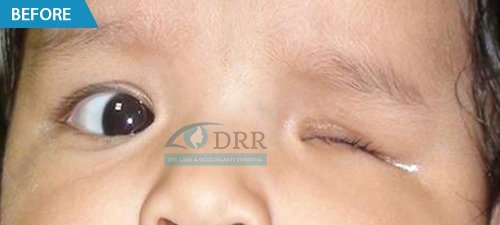 artificial eyes before treatment