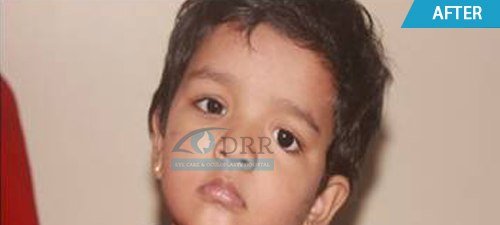 artificial eyes after treatment