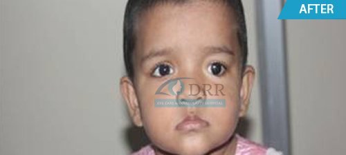 artificial eyes before treatment