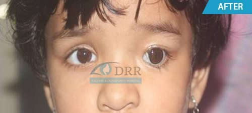 artificial eyes after treatment
