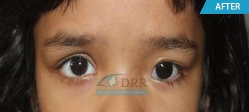 artificial eyes before treatment