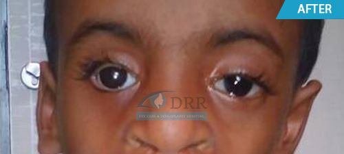 artificial eyes after treatment