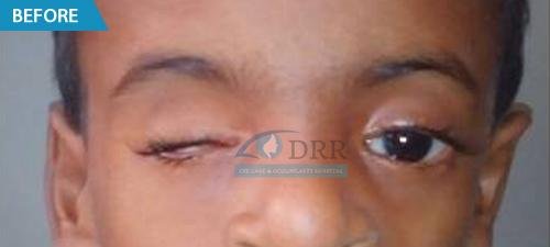 artificial eyes before treatment