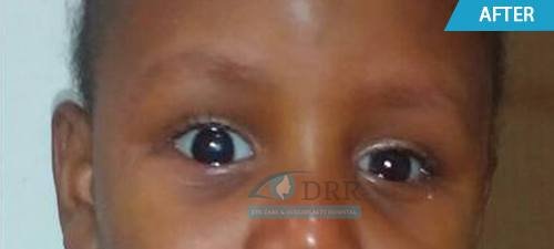 artificial eyes after treatment