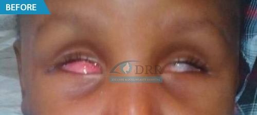 artificial eyes before treatment