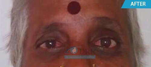 artificial eyes after treatment