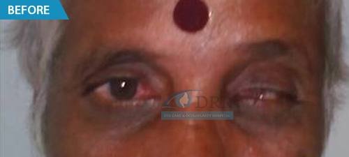 artificial eyes before treatment