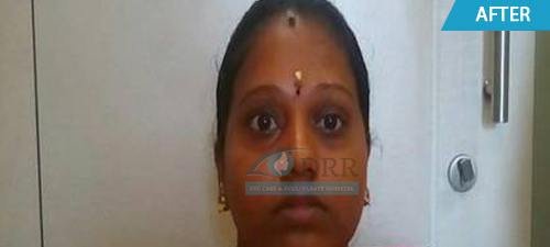 artificial eyes after treatment