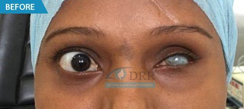 artificial eyes before treatment