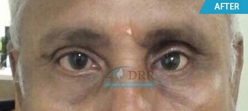 artificial eyes after treatment