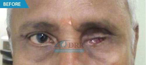 artificial eyes before treatment