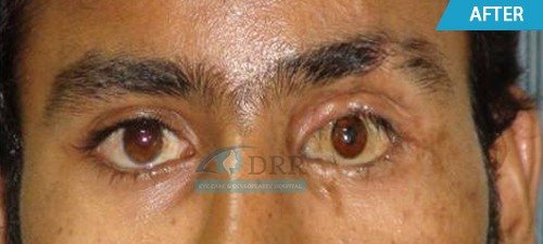 artificial eyes after treatment