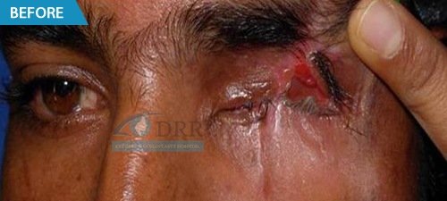 artificial eyes before treatment