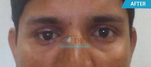 artificial eyes after treatment