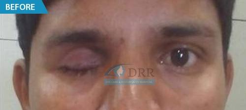 artificial eyes before treatment