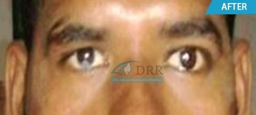 artificial eyes after treatment