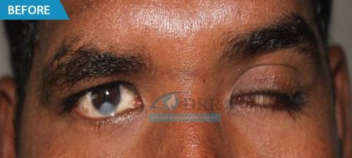 artificial eyes before treatment