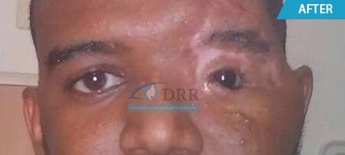 artificial eyes after treatment