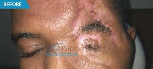 artificial eyes before treatment