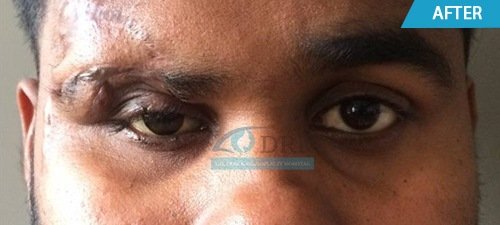 artificial eyes after treatment