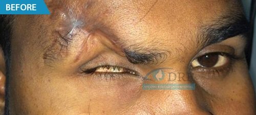 artificial eyes before treatment