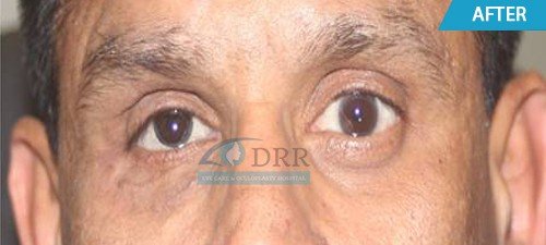 artificial eyes after treatment