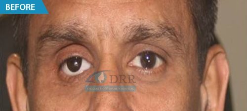 artificial eyes before treatment