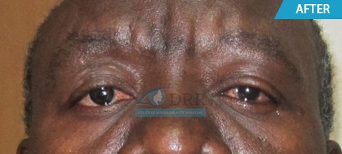 artificial eyes after treatment