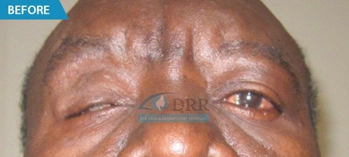 artificial eyes before treatment