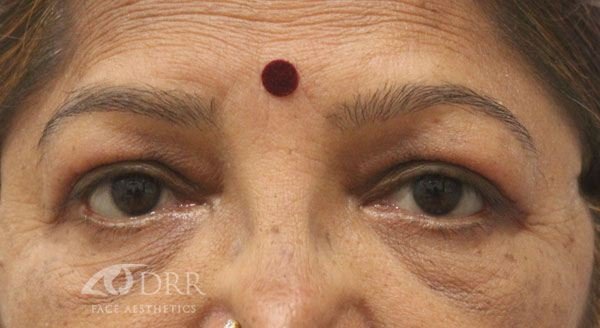 blepharoplasty after treatment
