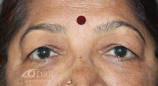 blepharoplasty before treatment