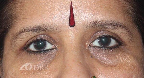 blepharoplasty after treatment