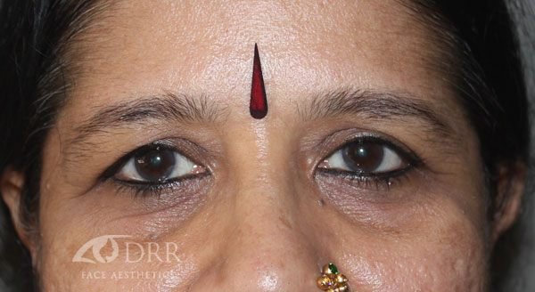 blepharoplasty before treatment