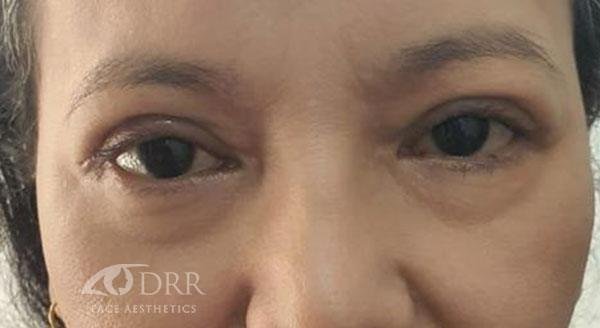 blepharoplasty after treatment