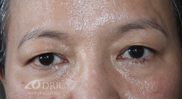 blepharoplasty before treatment