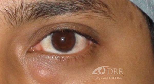 blepharoplasty before treatment