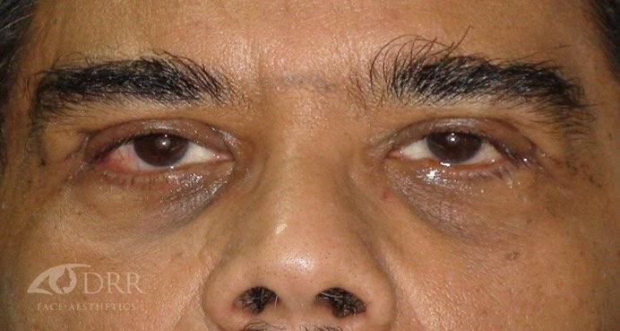 brow lift after treatment